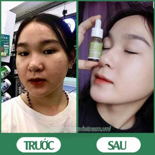 serum trị mụn diếp cá igreen