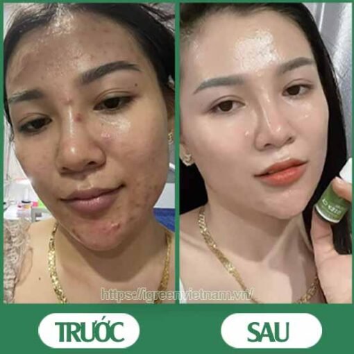 serum trị mụn diếp cá igreen