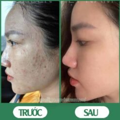 serum trị mụn diếp cá igreen